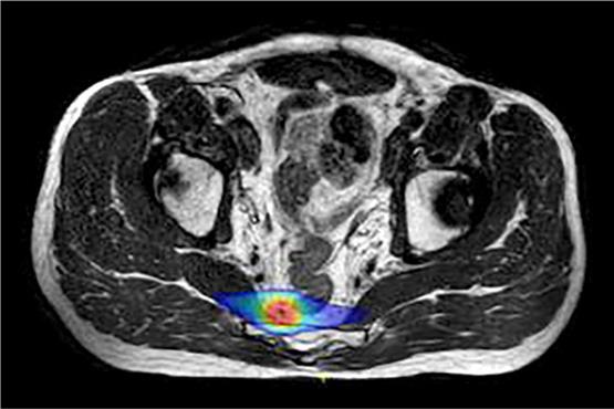 Diese MRT-Aufnahme zeigt die abgestufte Strahlendosis, mit der die Metastase behandelt wird: im Kern hoch (rot), am Rand niedrig (blau), um den danebenliegenden Enddarm zu schonen. Archivbild: UKT