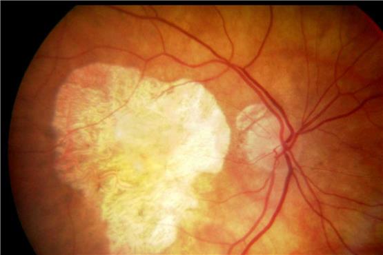 Ein Auge mit der trockenen Form der altersbedingten Makuladegeneration, eine häufige Ursache zu erblinden. Bild: University of Manchester